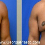 Pt 10, 2 years after male breast reduction with both liposuction and skin removal for Gynecomastia