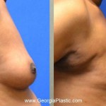Pt 12, 3 months after male breast reduction with only liposuction for gynecomastia